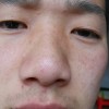 酒渣鼻应该如何进行保健