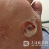 鸡眼治疗偏方有哪些可以使用呢
