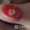 鸡眼常会发生在哪些部位呢