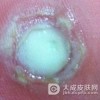 鸡眼要忌什么食物