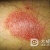 生殖器疱疹治疗了解病因很重要