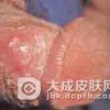 生殖器疱疹怎么防护