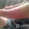 日光性皮炎夏天要注意什么