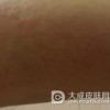 孩子日光性皮炎怎么护理