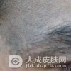 哪些原因引起的太田痣
