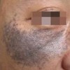 太田痣的病因以及发病机制