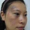 太田痣治疗有哪些方法