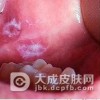 得了口腔白斑应该如何的治疗