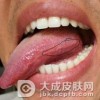口腔白斑如何的治疗