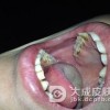 得了口腔白斑怎么的治疗