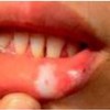 口腔白斑的临床表现的有哪些