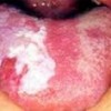 口腔白斑病会发生癌变吗