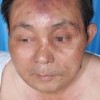 治疗寻常狼疮有什么方法