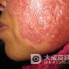 寻常狼疮怎样处理