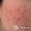 痤疮饮食注意的地方有哪些
