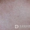 硬皮病的预防方法