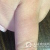 硬皮病的患者在日常饮食注意