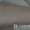 寻常性鱼鳞病的遗传特点是什么呢