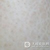 教你诊断寻常性鱼鳞病