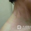 过敏性皮炎脱皮严重怎么办