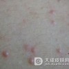 引起儿童过敏性皮炎的原因是什么