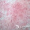 过敏性皮炎患者在饮食上的禁忌