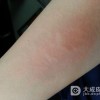 接触性皮炎的治疗方法有哪些