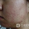 过敏性皮炎日常注意事项是什么