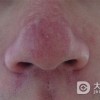 治疗酒槽鼻饮食很重要