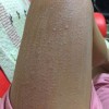 怎样治疗急性荨麻疹