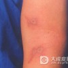 异位性皮炎是怎么来的