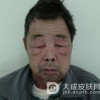 患上皮肌炎应该怎么办呢