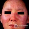 得了皮肌炎会出现红疙瘩吗