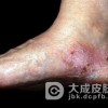 宝宝脚部角化型脚气预防的有效措施