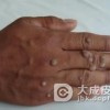 日常生活中怎样预防寻常疣