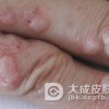 寻常疣如果不治疗会有什么后果