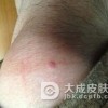 怎么有效治疗寻常疣