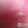 脓疱疮这种病有什么特点