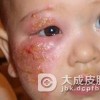 脓疱疮的症状表现是什么