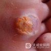 鸡眼膏治疗需要贴多久呢