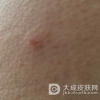一期梅毒是否能夠治愈啊