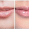 剥脱性唇炎的三大治疗原则是什么
