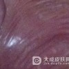 正确了解尖锐湿疣的注意事项