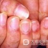 皮肌炎得病的原因是什么呢