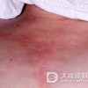 皮肌炎有哪些典型危害呢
