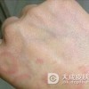 得了皮肌炎应该怎么办才好呢