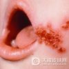 什么是传染性脓包疮