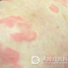 儿童脓包疮是怎么产生的呢