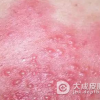 脓包疮是什么东西呢