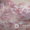 痤疮该怎样有效治疗